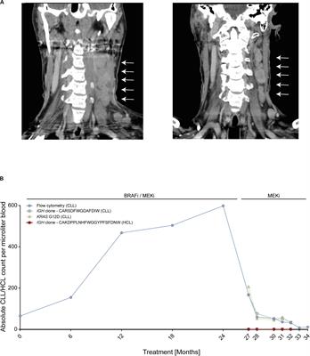 Targeting the Mutational Landscape of Bystander Cells: Drug-Promoted Blood Cancer From High-Prevalence Pre-neoplasias in Patients on BRAF Inhibitors